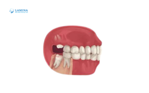 Răng khôn là răng ở đâu Vì sao ai cũng sợ mọc răng khôn