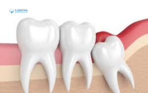 Răng khôn mọc 2 lần – sự thật hay hiểu lầm