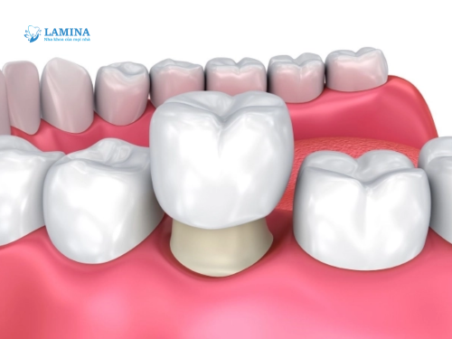 Răng giả bao nhiêu tiền? 