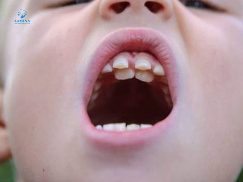 răng mọc trong vòm miệng