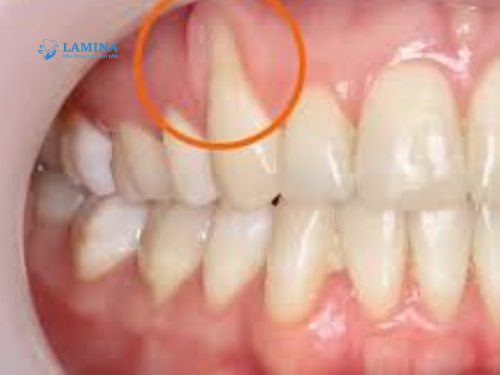 cách điều trị tụt lợi nặng