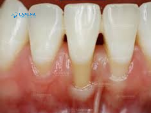 Nguyên nhân tụt lợi nặng