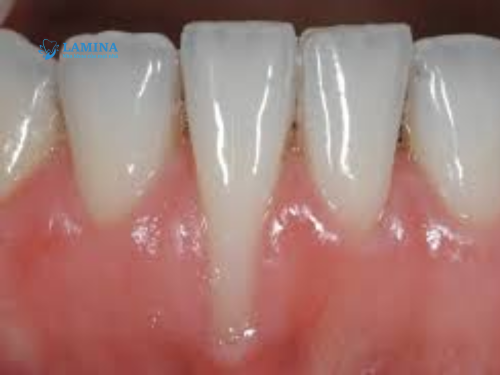 Tác hại tụt lợi nặng