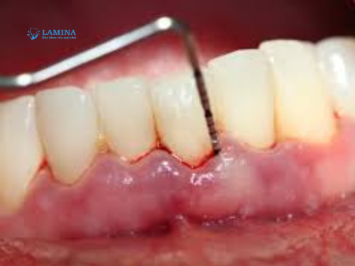 tác hại viêm nha chu