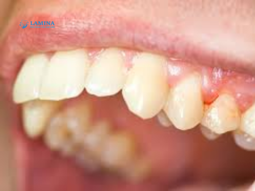 Nguyên nhân viêm nha chu