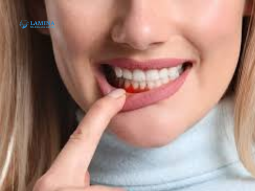 Tình trạng viêm nha chu nặng