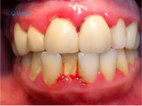 Cách điều trị viêm nha chu nặng