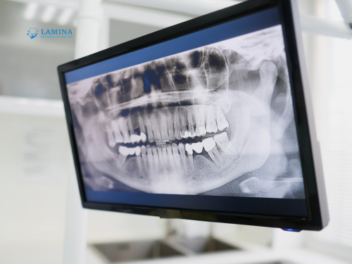 chụp x quang răng khôn bao nhiêu tiền