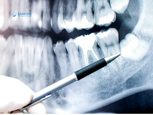 chụp x quang răng khôn bao nhiêu tiền