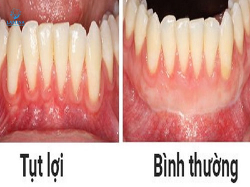 tụt lợi hàm dưới dấu hiệu