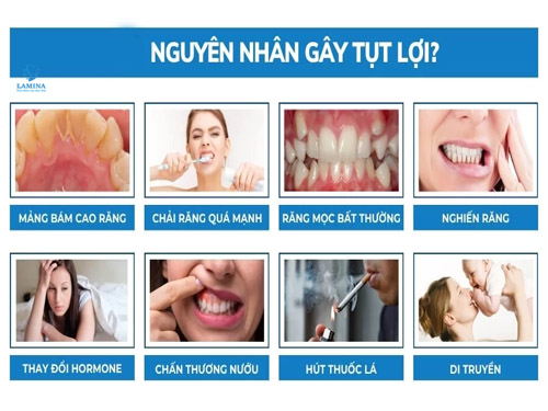 nguyên nhân tụt lợi hàm dưới