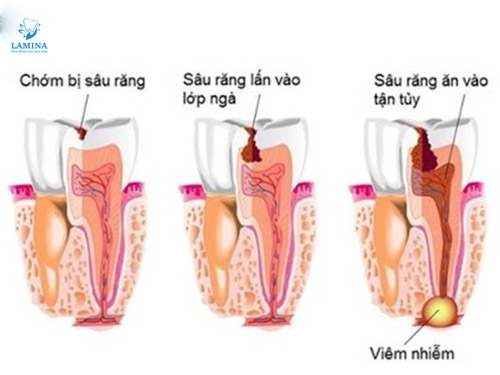sâu răng vào tuỷ quá trình sâu
