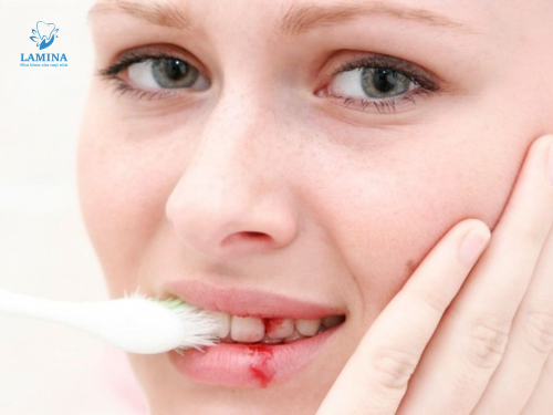 Trị viêm nha chu tại nhà: Chải răng sai cách