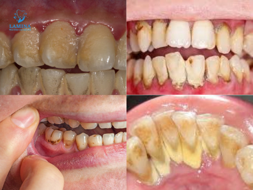 Trị viêm nha chu tại nhà: Dấu hiệu nhận biết