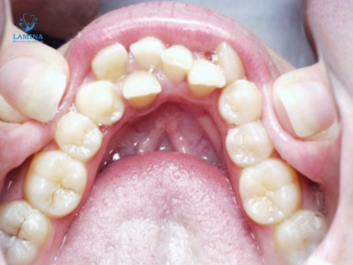 Trị viêm nha chu tại nhà: Răng chen chúc, mọc lệch