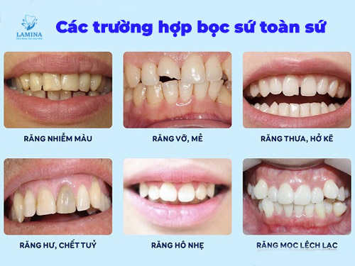 các trường hợp bọc sứ toàn sứ