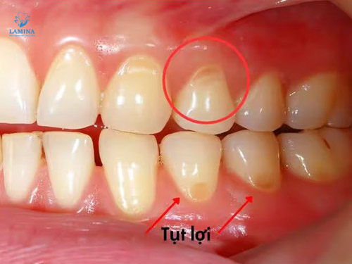tụt lợi hàm dưới