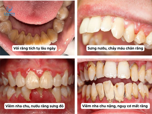 viêm nha chu là bị gì nguyên nhân