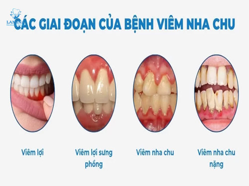 viêm nha chu là bị gì các giai đoạn