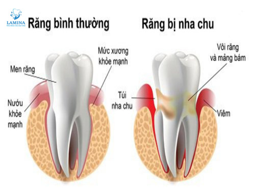 viêm nha chu là bị gì