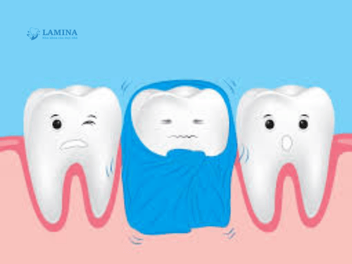 Ê răng: Nguyên nhân, dấu hiệu và 9 cách điều trị dứt điểm tại nha khoa