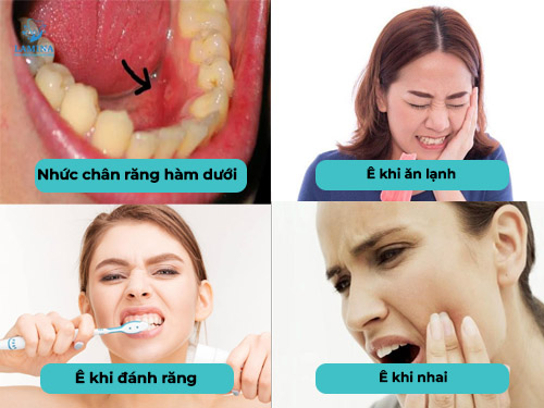 ê răng hàm dưới dâu hiệu