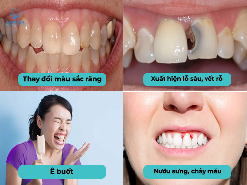 dấu hiệu sâu răng cửa