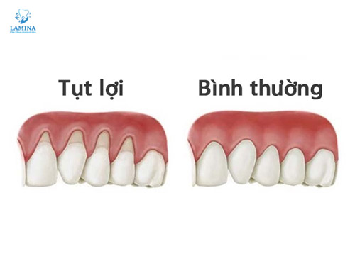 tụt lợi chân răng dấu hiệu