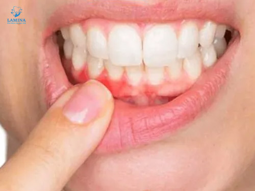 ê răng hàm dưới