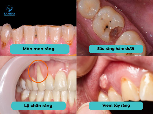 nguyên nhân ê răng hàm dưới