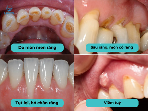 nguyên nhân răng nhạy cảm