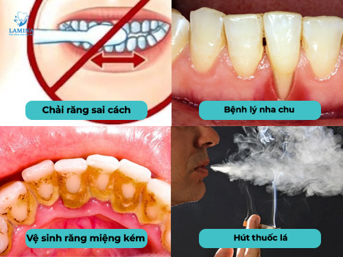 tụt lợi chân răng nguyên nhân
