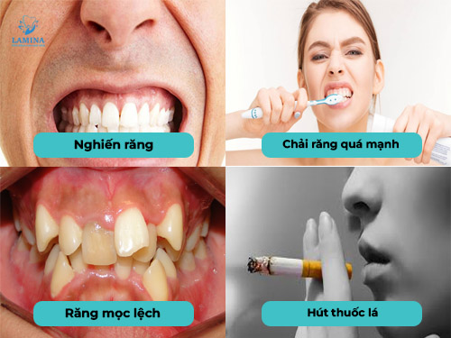 tụt lợi hở chân răng nguyên nhân