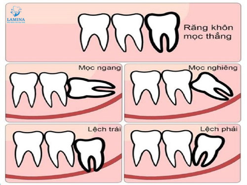 răng số 8 trường hợp nhổ