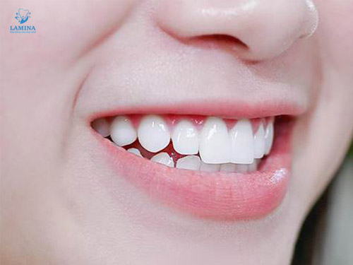 hình ảnh răng thỏ