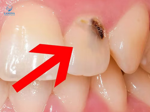 dấu hiệu sâu răng đen