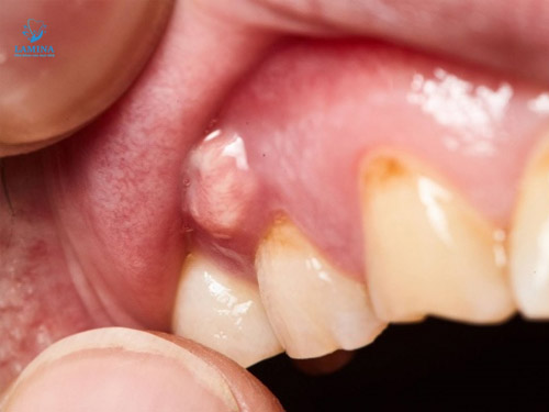 tác hại sâu răng đen