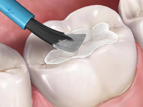 sâu răng đen trám thẩm mỹ