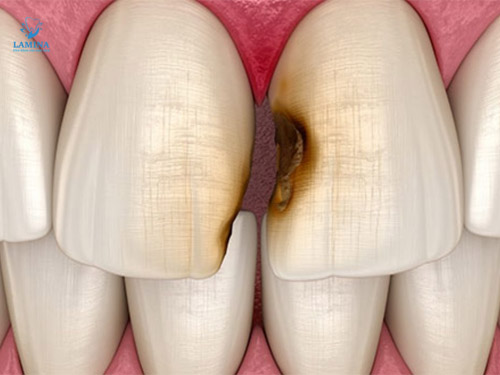 hình ảnh sâu răng đen