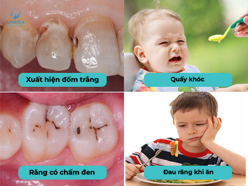 sâu răng em bé dấu hiệu