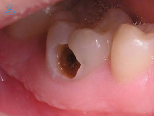 sâu răng em bé lỗ sâu