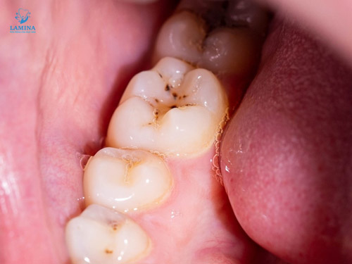 sâu răng em bé mới chớm