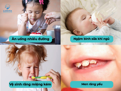 sâu răng em bé nguyên nhân