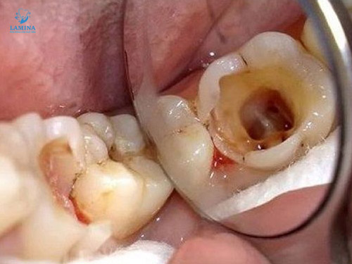 sâu răng em bé nặng