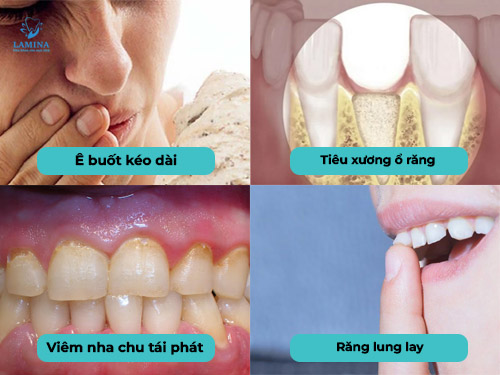 tụt lợi chân răng tác hại