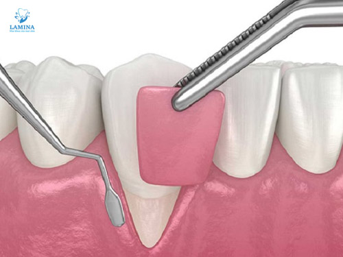 tụt lợi chân răng ghép mô nướu