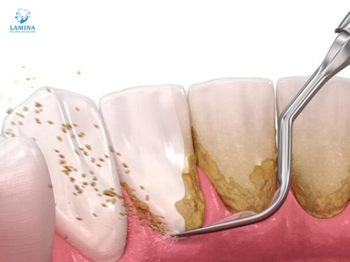 tụt lợi chân răng lấy cao răng