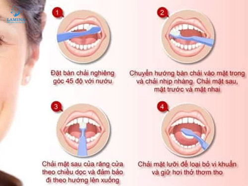 tụt lợi hở chân răng chăm sóc răng miệng đúng cách