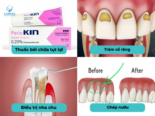tụt lợi hở chân răng cách điều trị