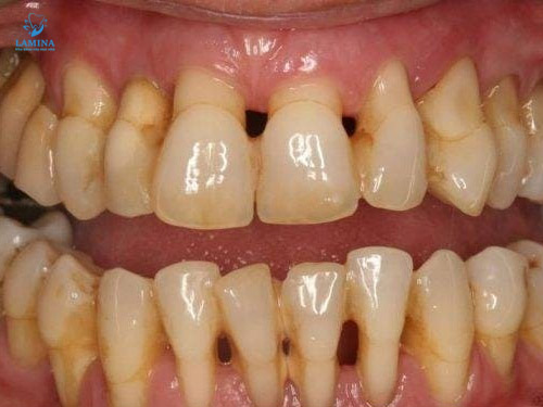 tụt lợi hở chân răng